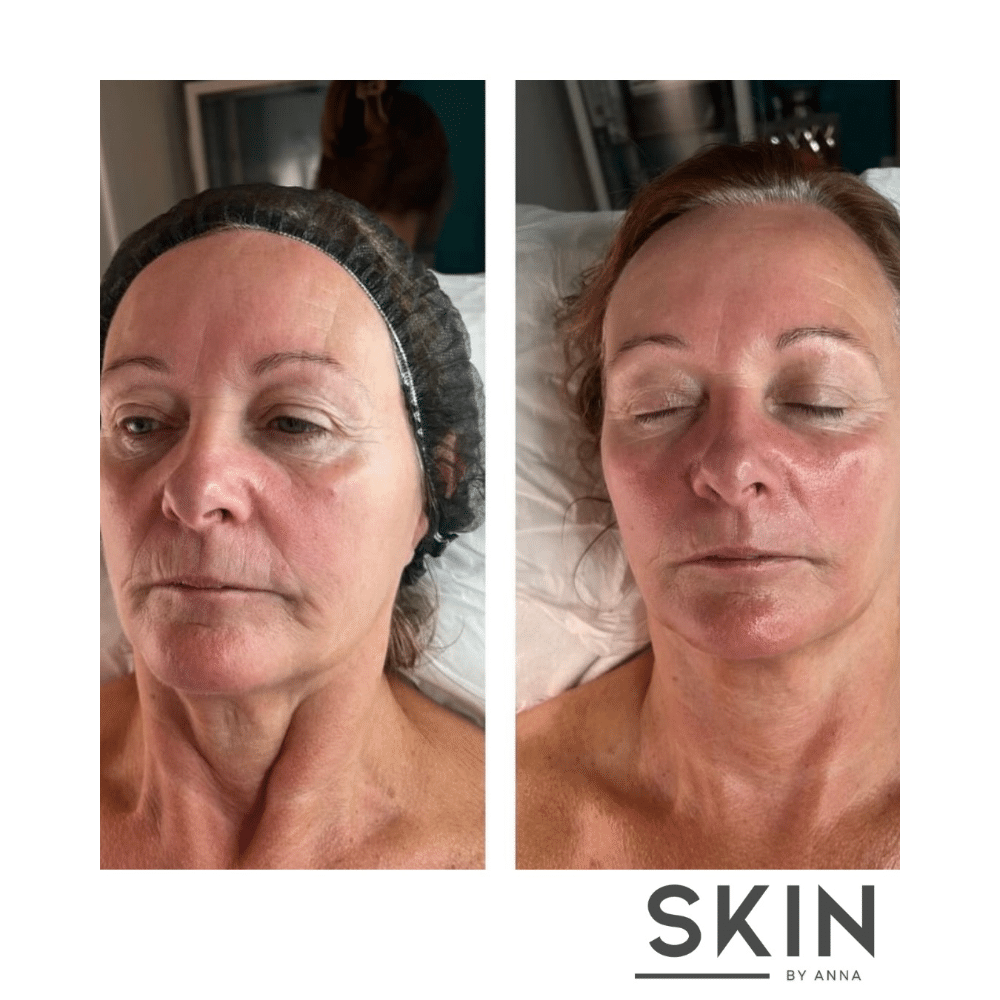 Before and after skincare treatment on an older woman, showing improved facial appearance.