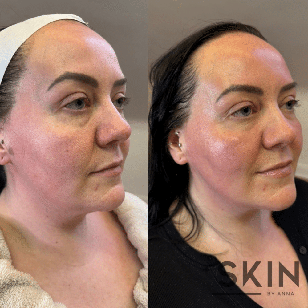 Before and after skincare treatment of a woman's face, showing improved skin texture and tone.