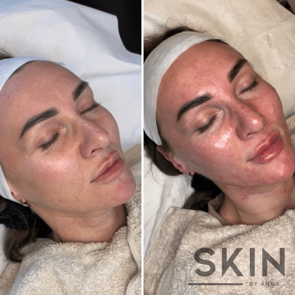 Before and after skincare treatment comparison showing facial improvements.