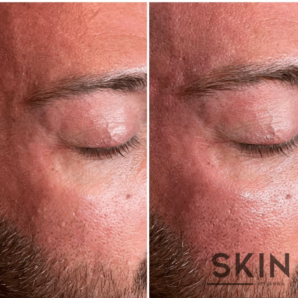 Close-up comparison of a man's closed eye and cheek skin before and after a skincare treatment.