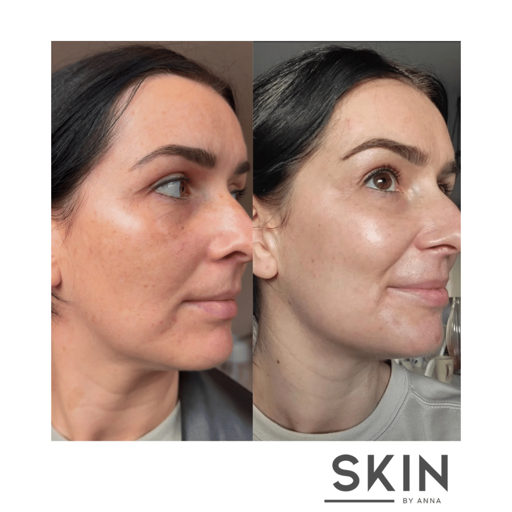 Side-by-side comparison of a woman's face before and after skincare treatment, showing improved skin texture.