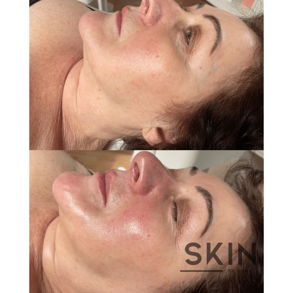 Before and after skincare treatment showing improved skin texture on a woman's face.